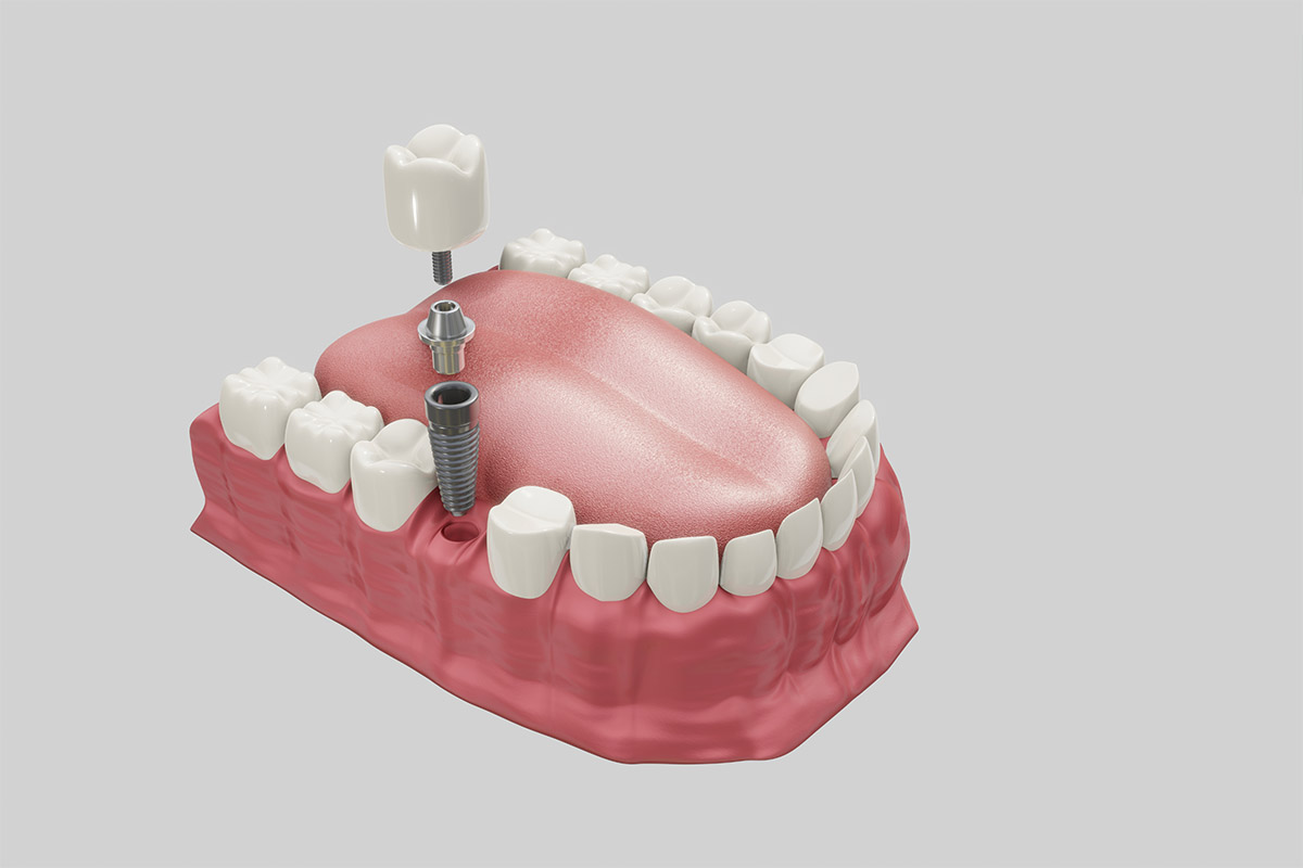 Dental Implant 2