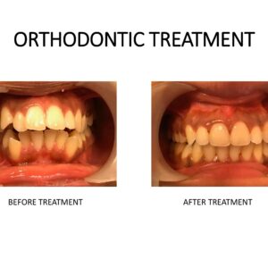 PRE AND POST OP